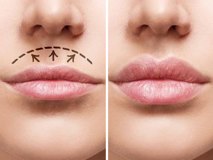 لیفت سانترال لب چگونه به برجسته شدن لبها کمک میکند؟ + جزییات آن