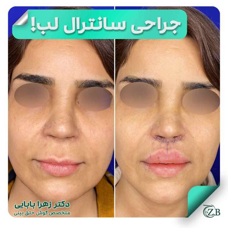 سانترال لب آیا روشی دائمی است یا مثل فیلر نیاز به تمدید دارد؟