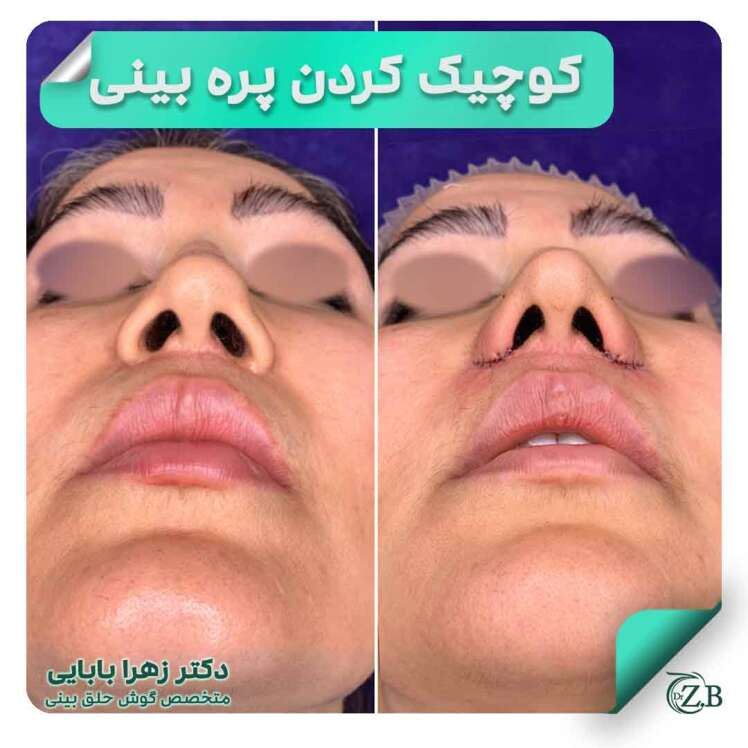 ایلارپلاستی ، زیبایی بینی بدون بیهوشی!