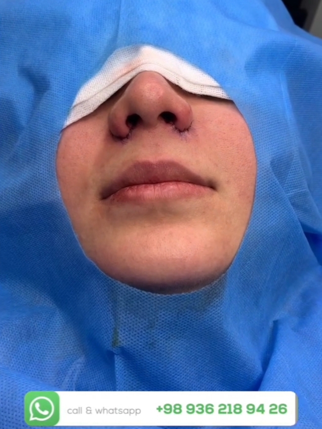 آلارپلاستی بینی (Alarplasty) چیست؟